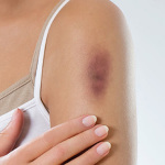 como curar un hematoma o morado